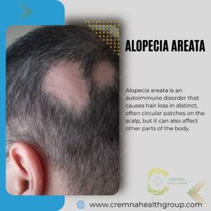 Alopecia-Areata-Causes-and-Treatments