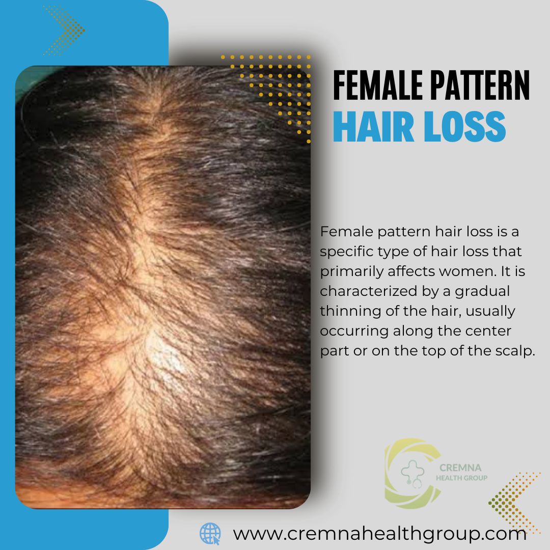 picture that telling female pattern hair loss